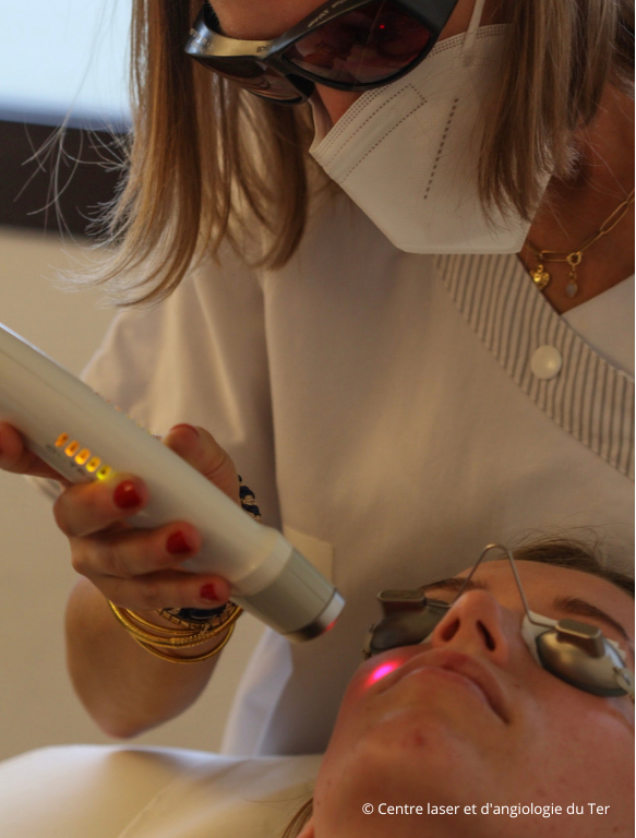 séance de réjuvénation du visage avec le laser genesis de Cutera. Centre laser du Ter.