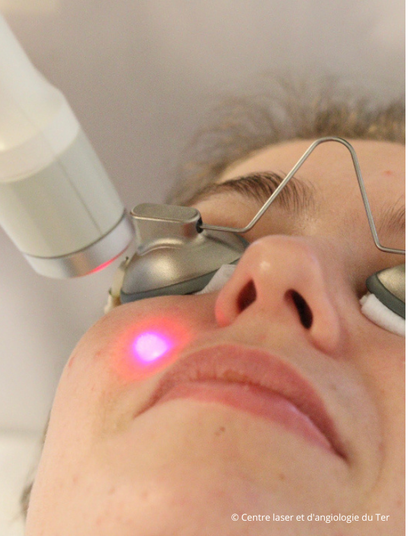 Réjuvénation du visage au Centre laser du Ter.