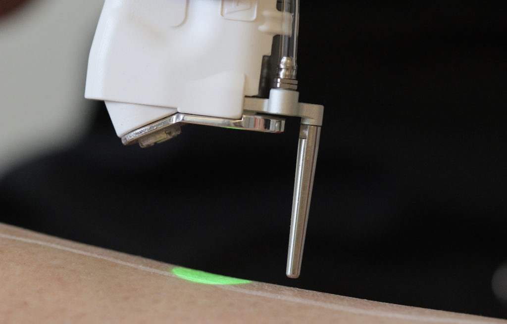 Machine laser en action sur la zone des jambes, dans le cadre d'une séance d'épilation au Centre Laser du Ter.