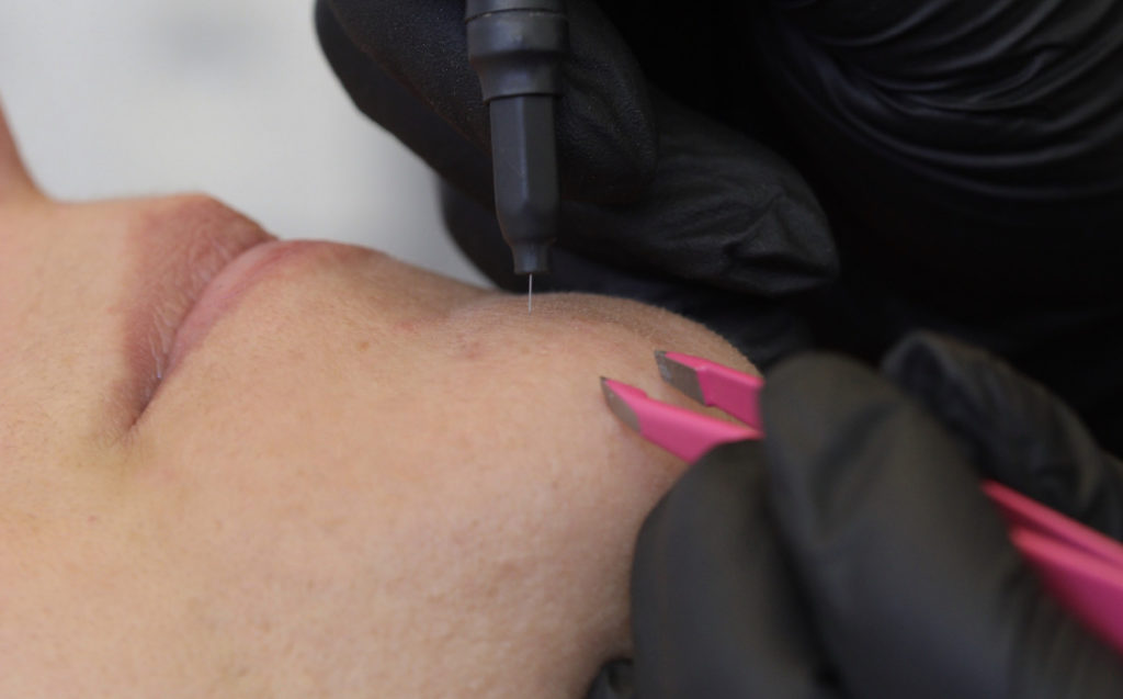 Épilation du menton durant une séance d'épilation par électrolyse au Centre laser et d'angiologie du Ter.