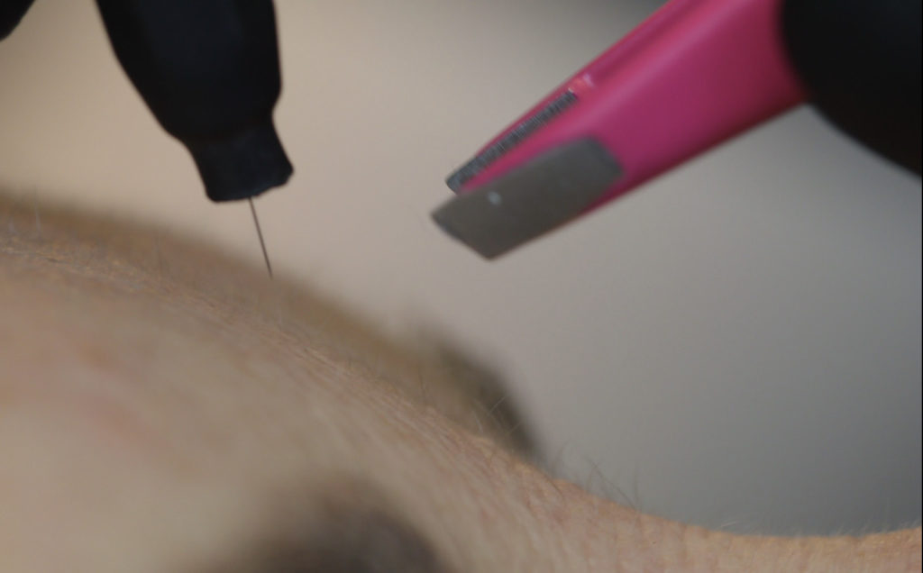 Séance d'épilation par électrolyse au Centre laser et d'angiologie du Ter.