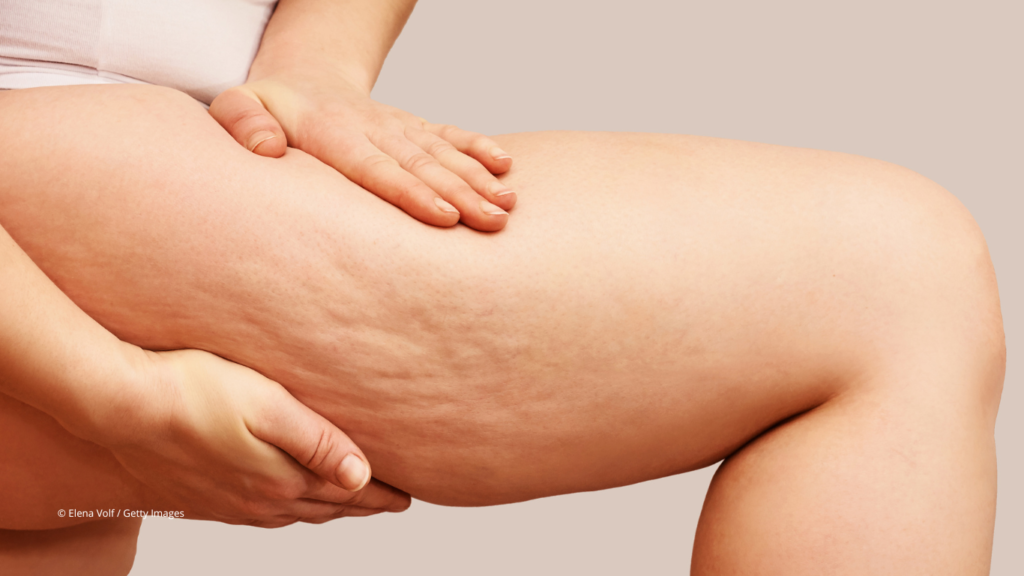 La lipolyse permet de tonifier la peau et d'effacer la cellulite principalement visible sur les bras et les cuisses.