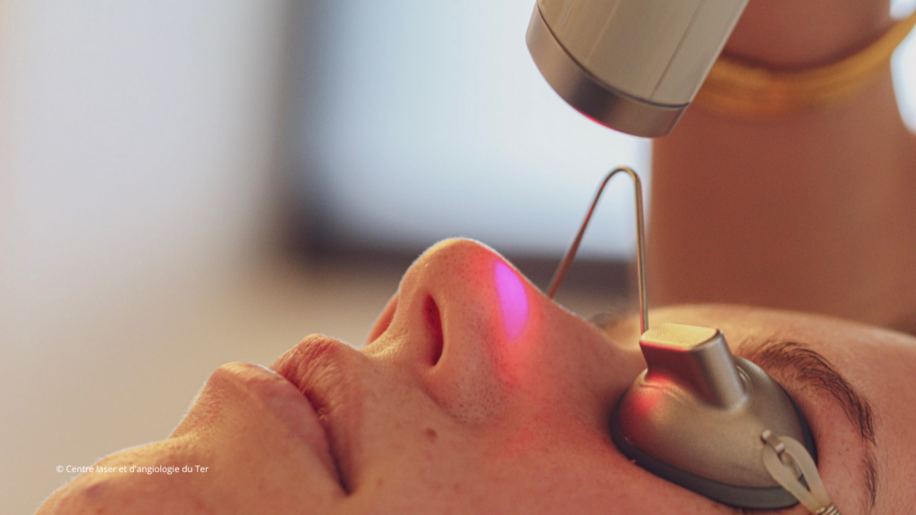 Patiente au cours d'une séance de réjuvénation laser au Centre laser et d'angiologie du Ter.