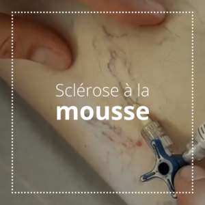 Sclérothérapie à la mousse Centre laser et d'angiologie du Ter