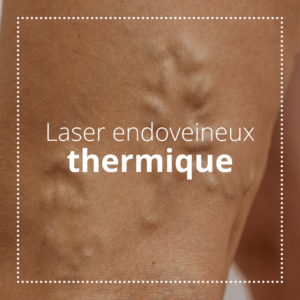 laser endoveineux thermique