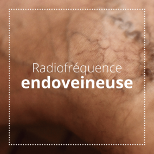 radiofréquence endoveineuse