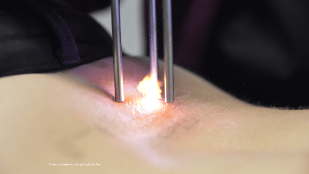 Intervention laser sur tatouage lombaire (bas du dos) au Centre laser du Ter.