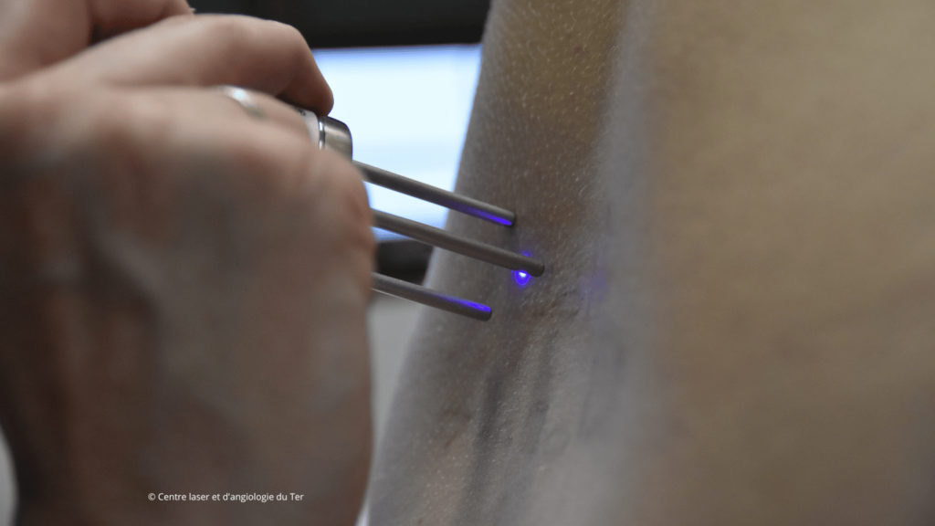 Séance de détatouage avec le laser enlighten de Cutera au Centre laser du Ter.