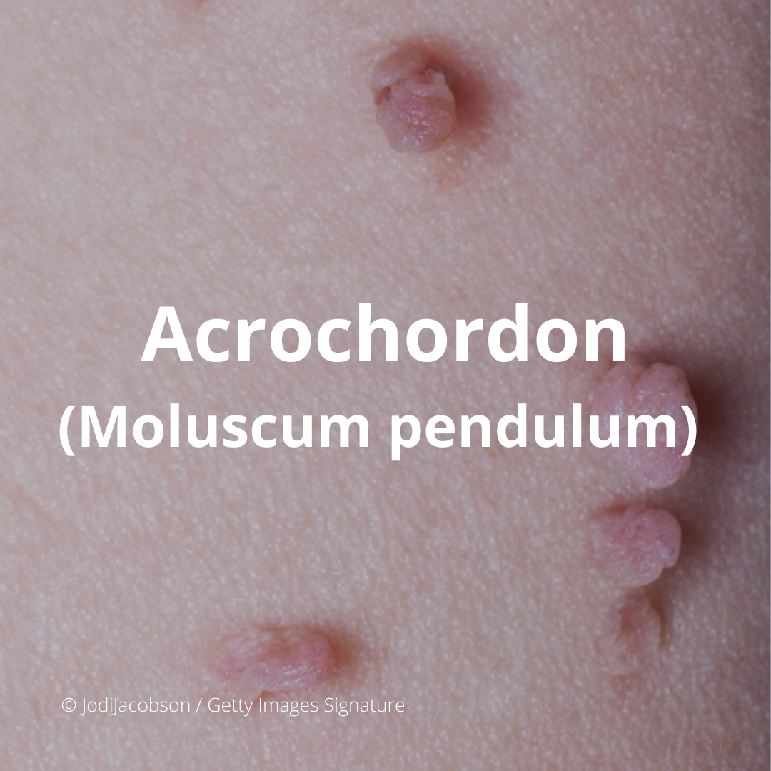 Acrochordon (moluscum pendulum)