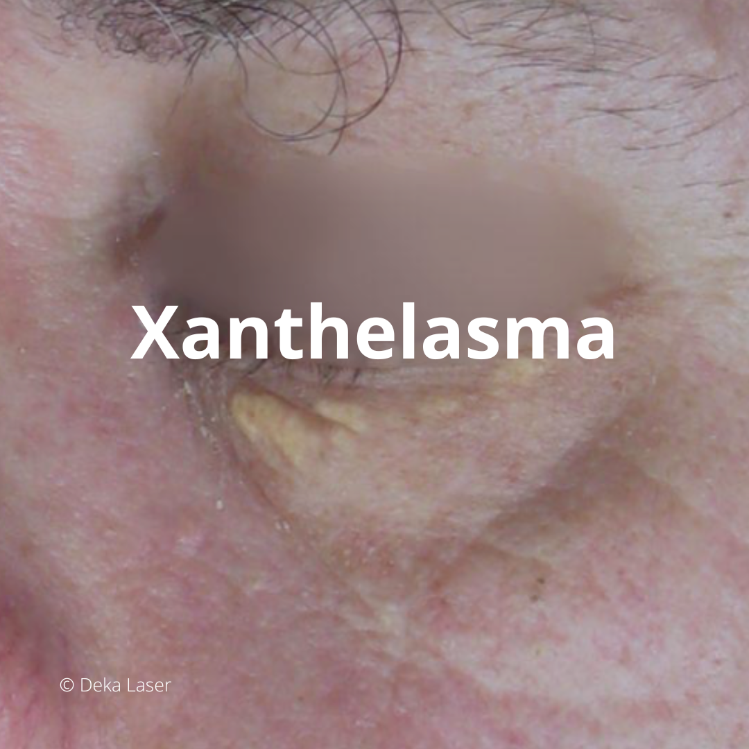 Xanthelasma, plaque jaune