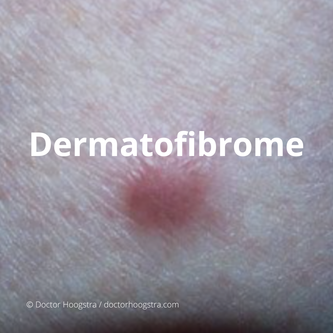 Dermatofibrome, lésion nodulaire