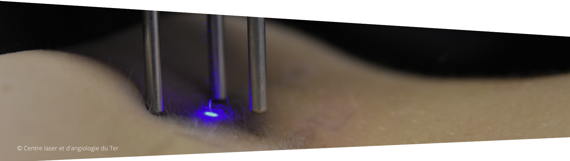 Séance de détatouage laser au Centre laser du Ter